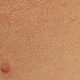 Methods to Remove Skin Tags